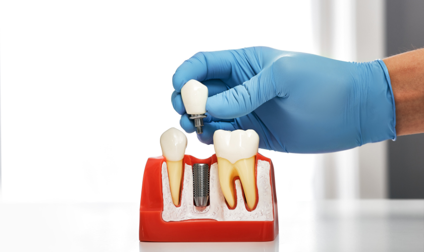 Implant Dentistry Innovations What’s New in the World of Dental Implants